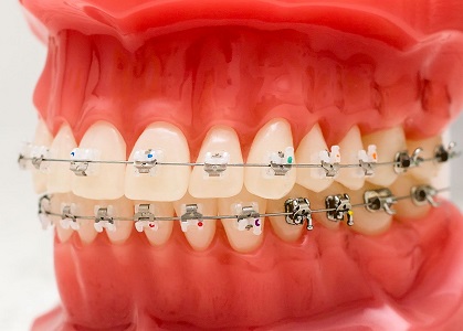 Dental Implants